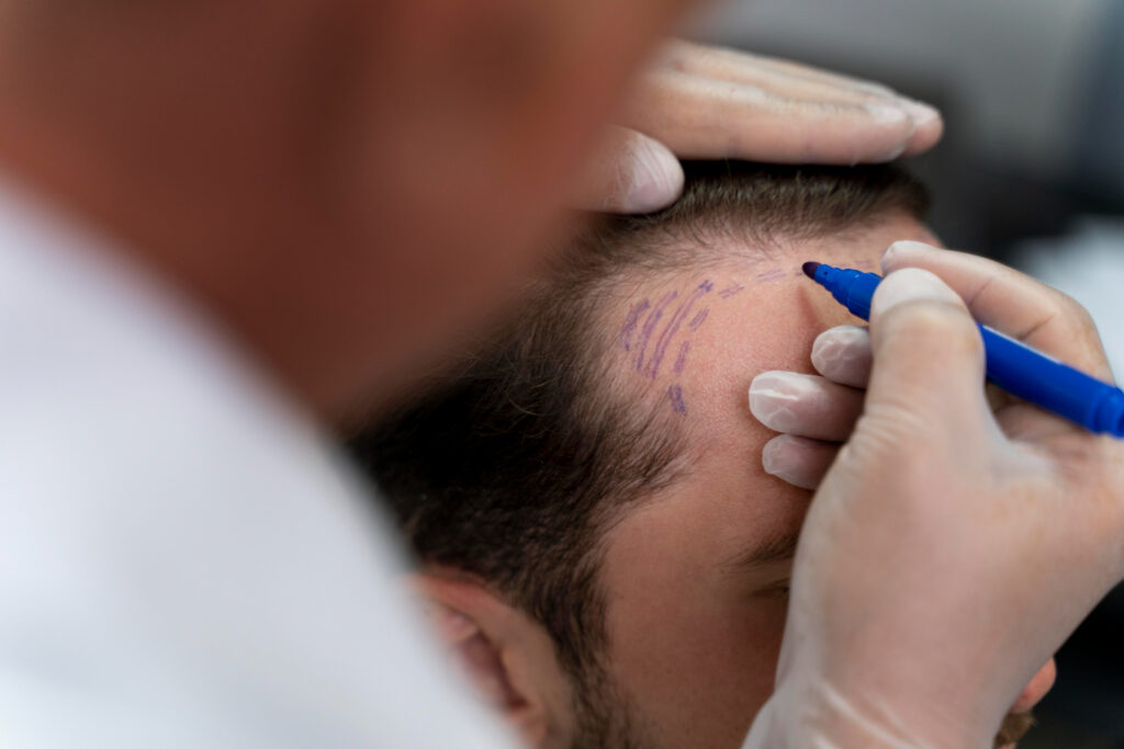 Man undergoing hair transplant after assessing the risks of hair transplant