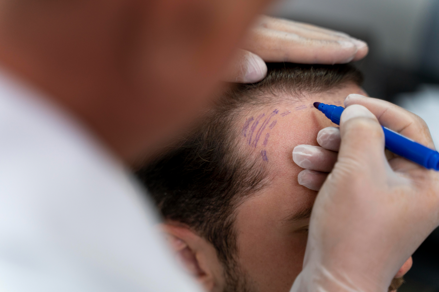 Man undergoing hair transplant after assessing the risks of hair transplant