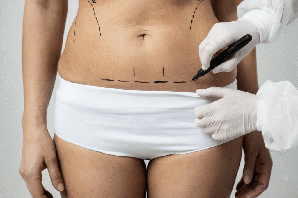 woman getting prepared for a liposuction in Brazil