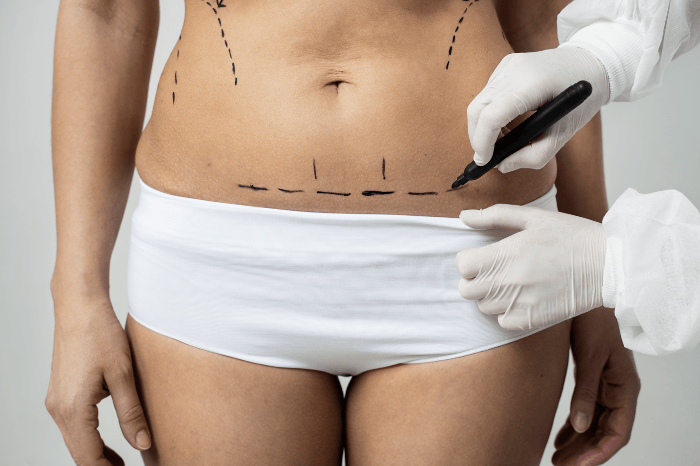 woman getting prepared for a liposuction in Brazil
