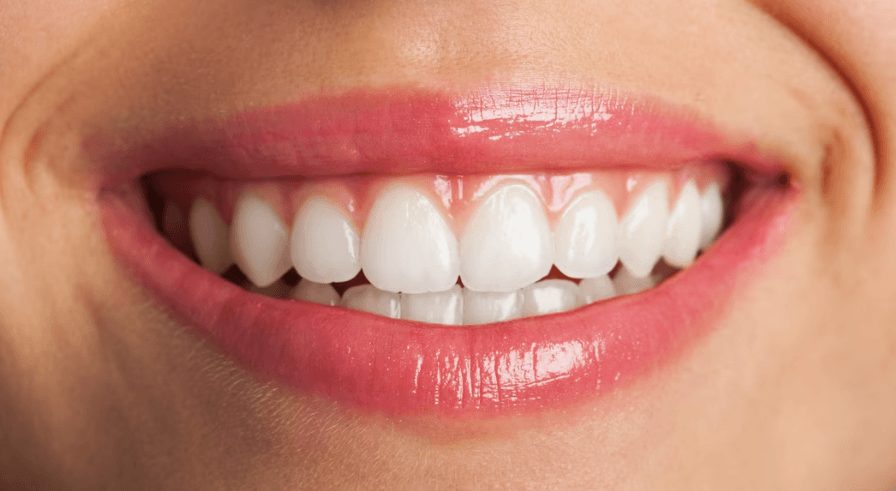 woman exibing porcelain veneers in brazil