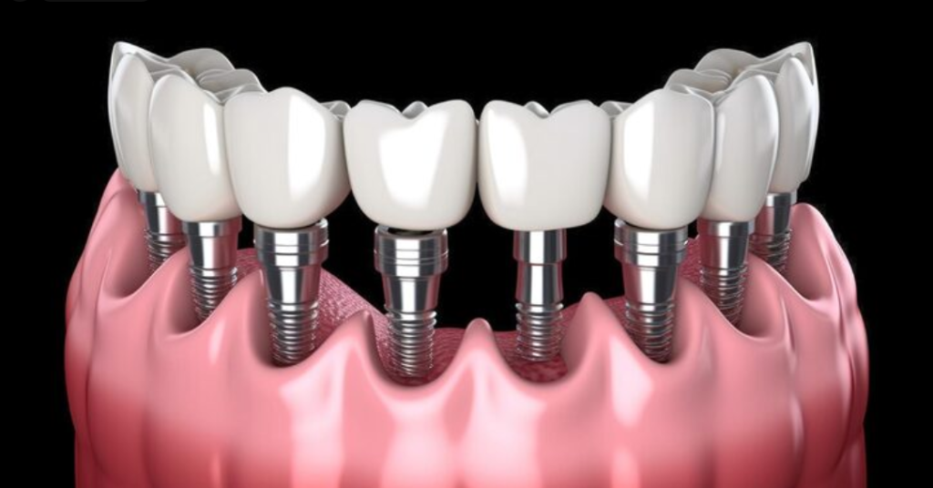All-on-6 Implants in Brazil protesis