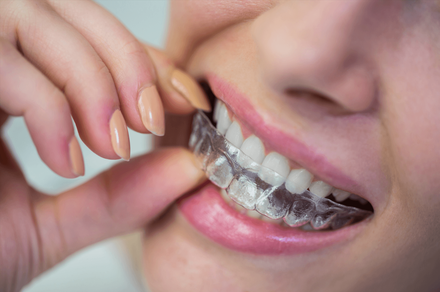 woman wearing Invisalign in Brazil